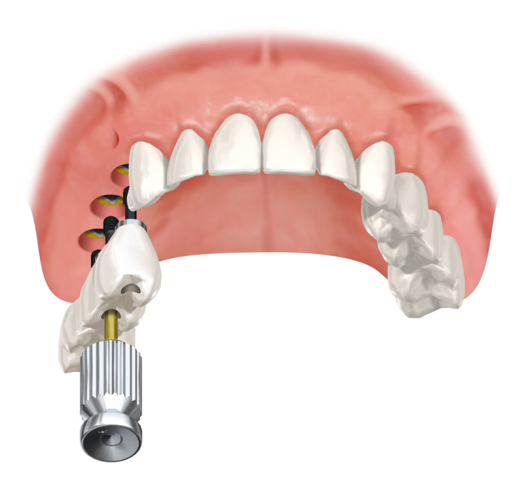 Трансгингивальная имплантация. Трансгингивальная имплантация зубов. Базальная имплантация зубов верхней челюсти. Имплант 4 зуба верхней челюсти. 3 зуба установить